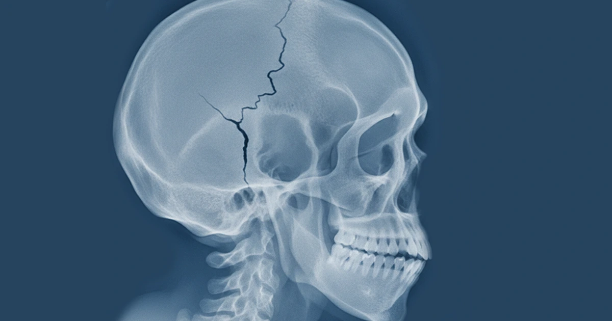 X-ray of a skull with a visible fracture line.